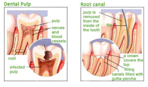 Diagram - Infected Tooth