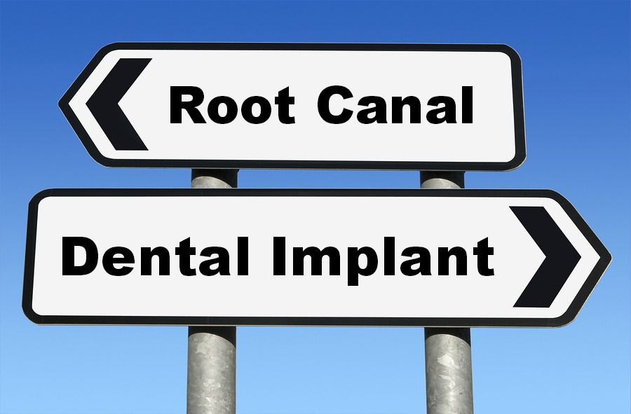 Root Canal Cost vs. Cost of Implant