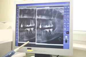 Root_canal 