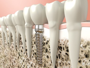 What is Implantology?