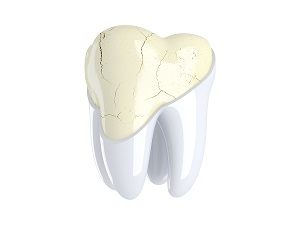 Cracked Teeth vs. Split Teeth