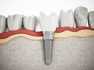 Dental_Implant