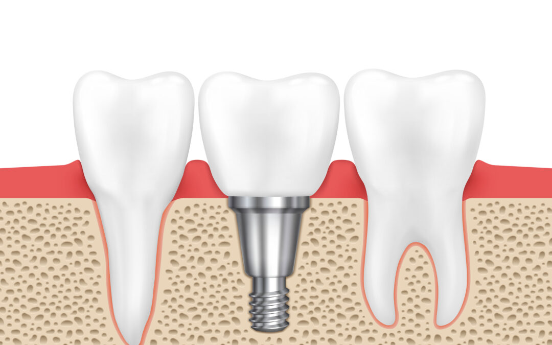 4 Myths About Dental Implants