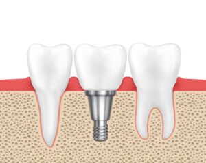 Dental_implants