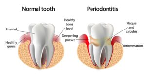 Gum_disease 