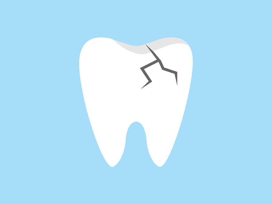 Solutions for Cracked Teeth