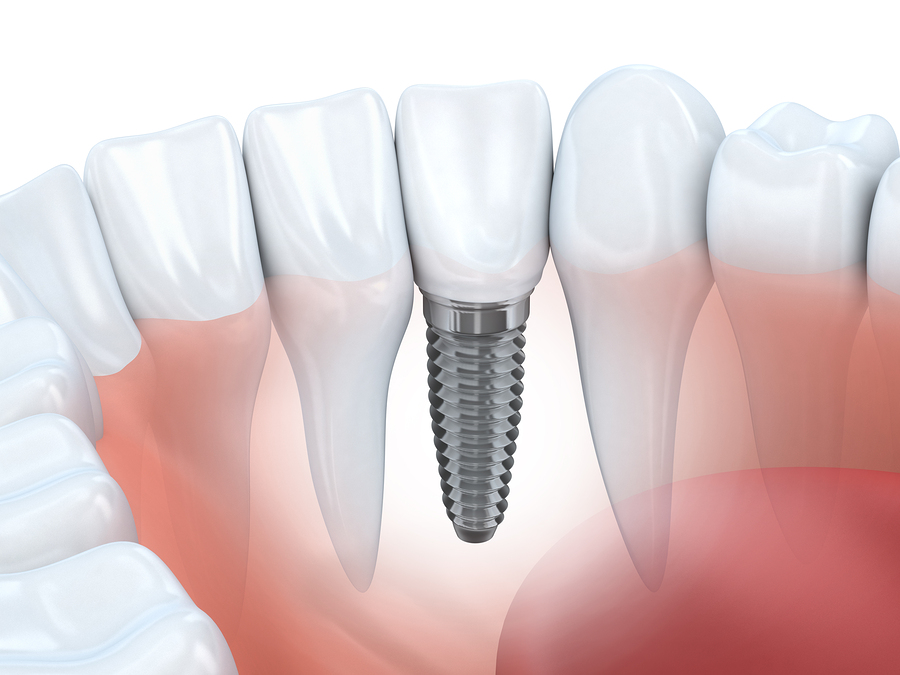 Am I A Good Candidate For A Dental Implant?