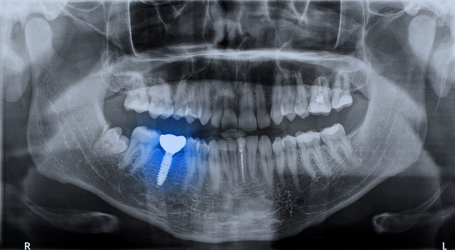 How Soon After Tooth Extraction Can You Have A Dental Implant?