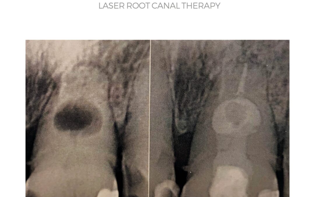 How is Laser Used in Root Canal Treatment?