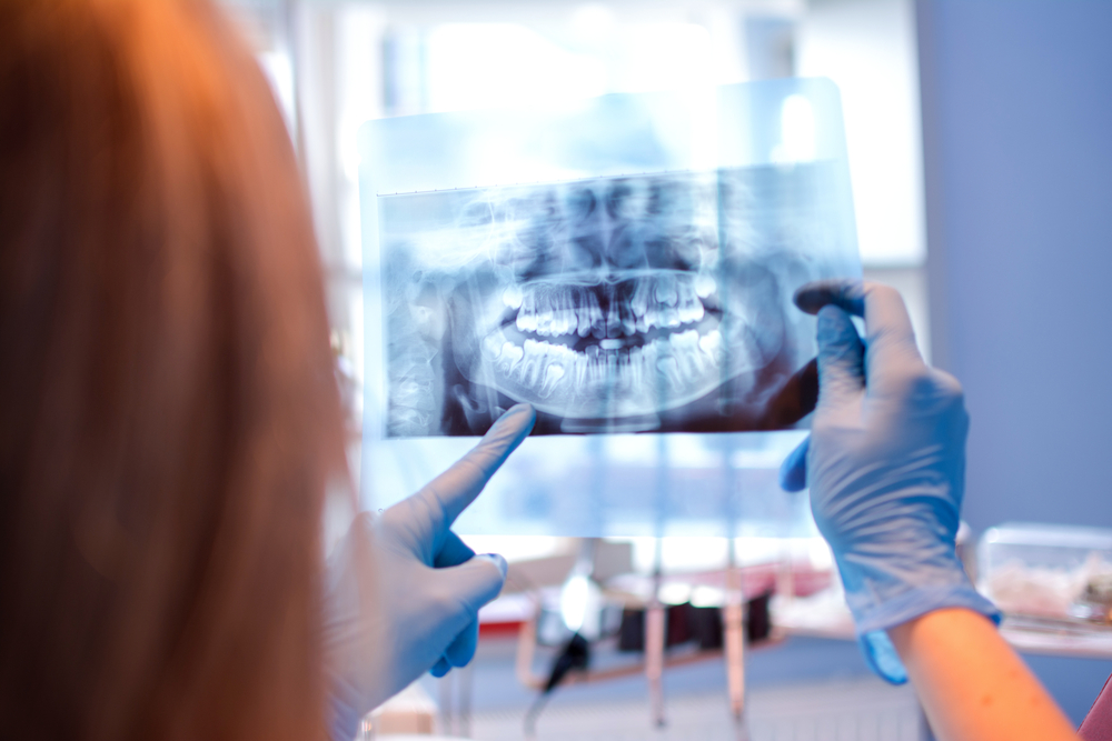 Which is Better – Root Canal or Extraction?