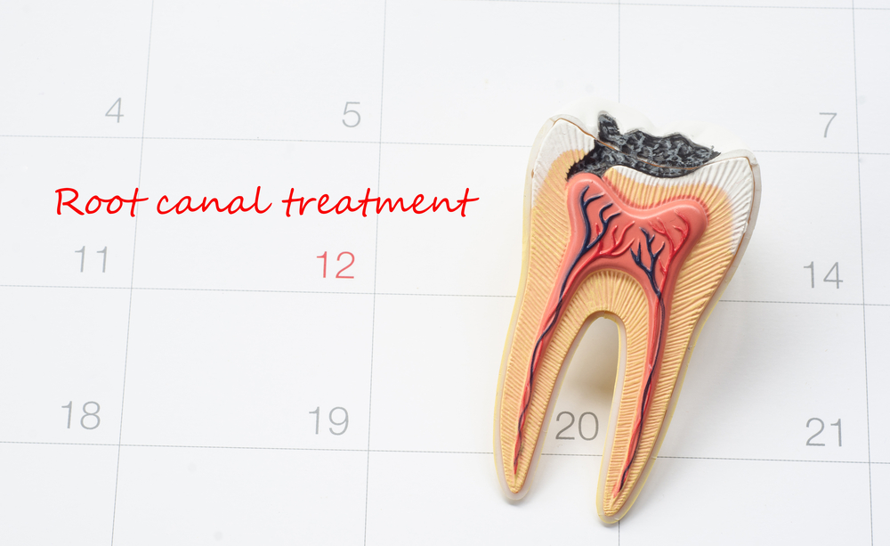 5 Tips To Avoid A Root Canal