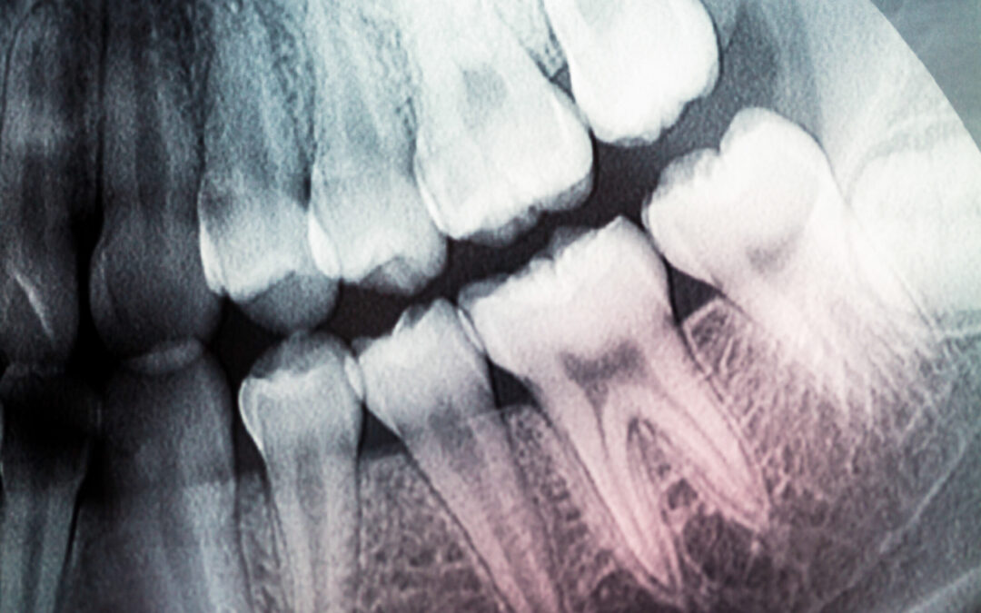 Does A Root Canal Kill The Tooth?