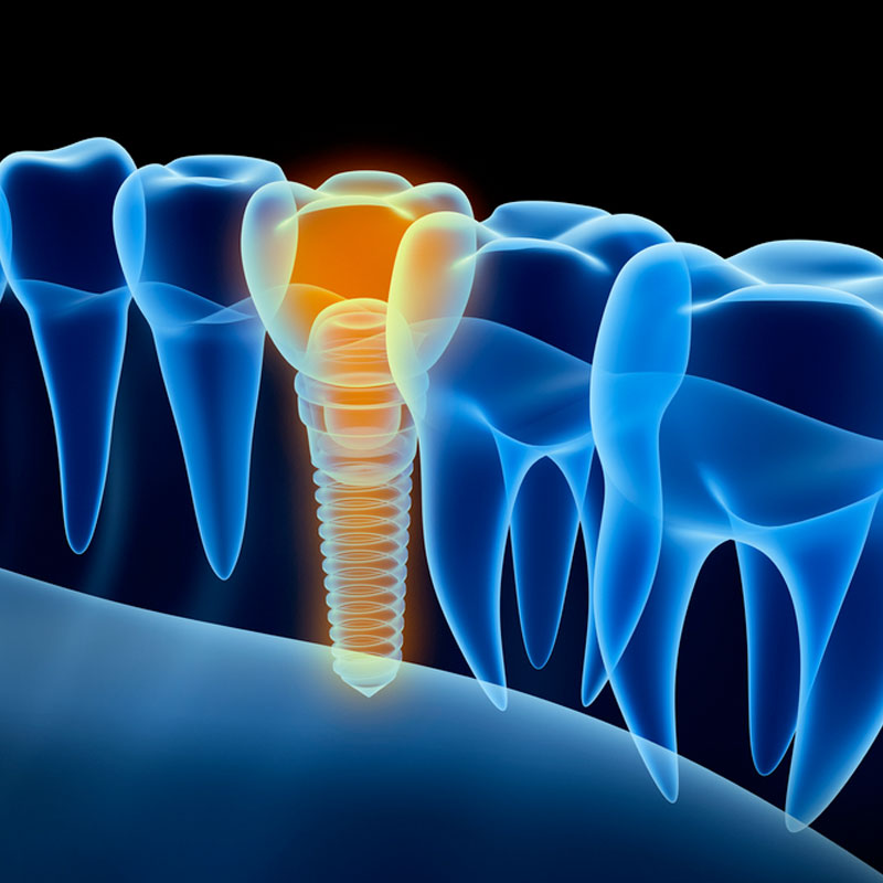 Apicoectomy