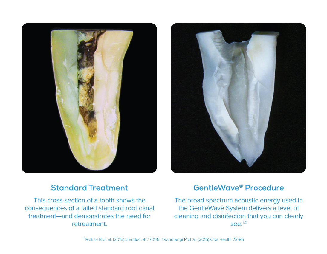 gentlewave-procedure-root-canal-therapy