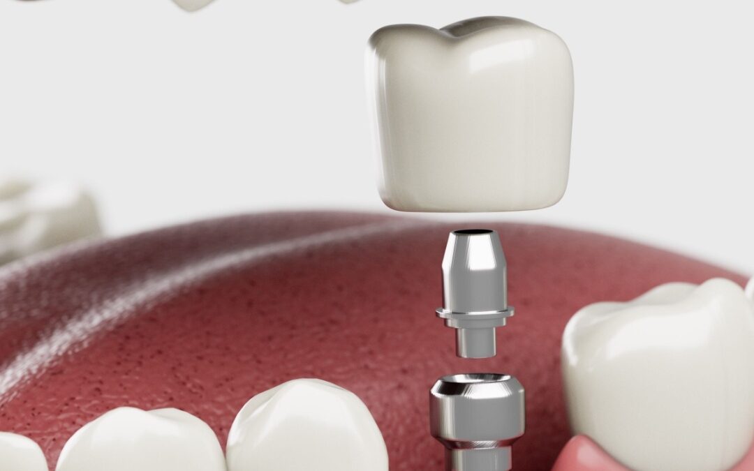 5 Things to Know About Dental Implants