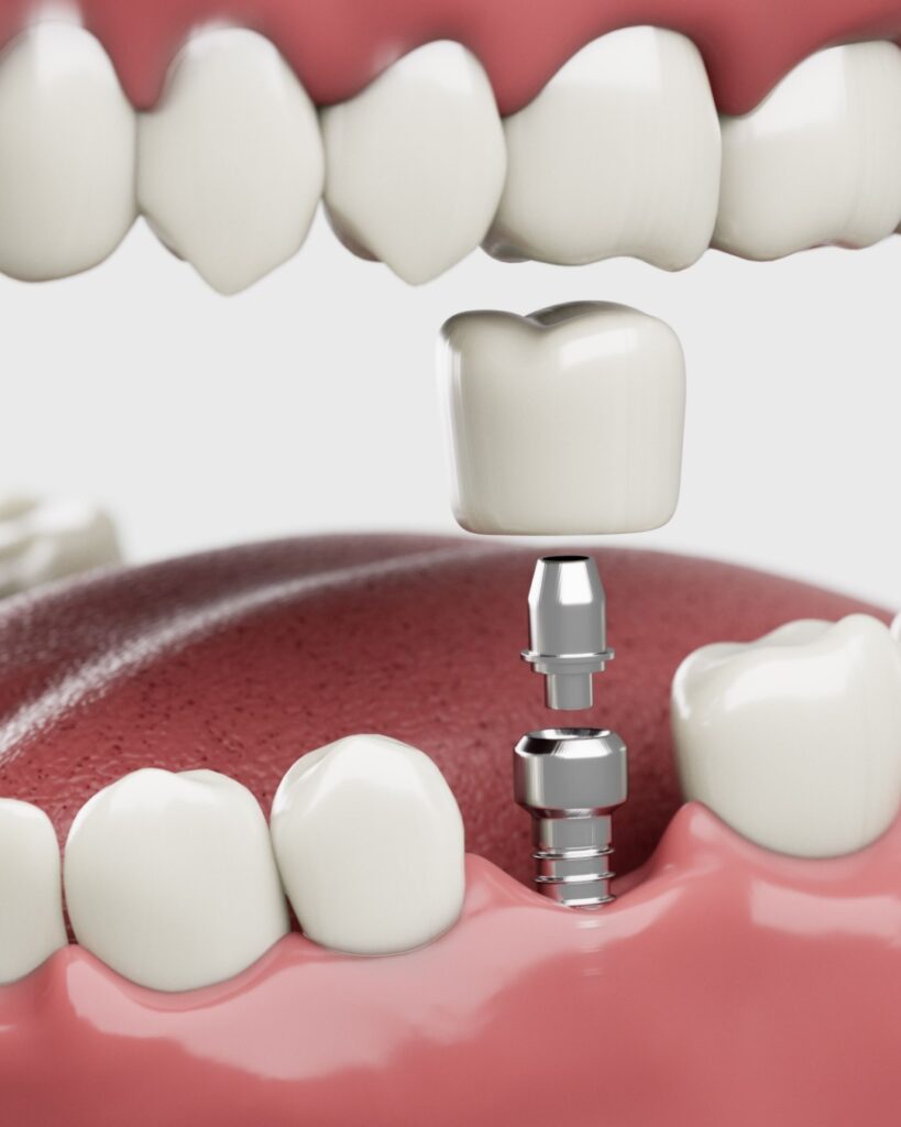 dental-implant-information-phoenix-endodontist